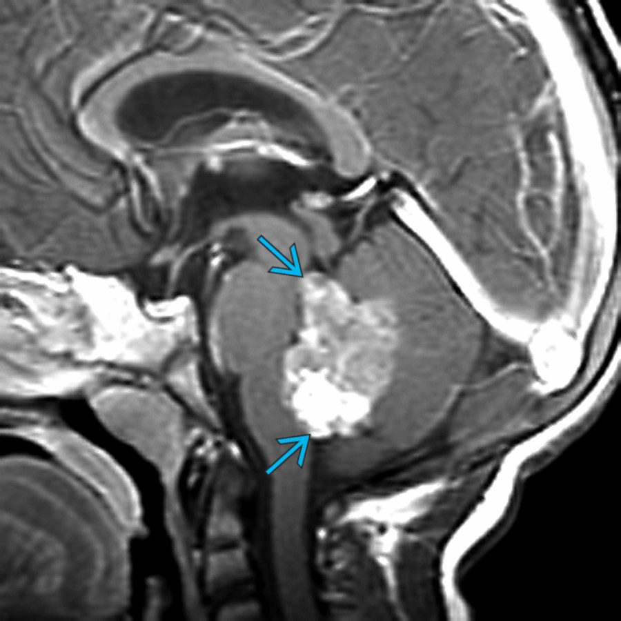 Sagittal T1WI C+ MR in a 2 year old with ataxia, nausea, and vomiting shows a lobulated enhancing mass in the 4th ventricle . Fourth ventricle masses in children are usually primitive neuroectodermal tumor or ependymoma, less often atypical teratoid-rhabdoid tumor which was found at surgery.