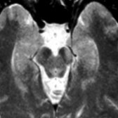 Axial T2WI MR in a patient with left middle cerebral artery infarct (not shown) shows high signal intensity in the left cerebral peduncle , consistent with WaD.