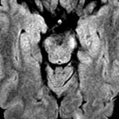 Axial FLAIR image in the same patient shows mild atrophy and hyperintense signal in bilateral cerebral peduncles . Considering atrophy of cerebral peduncles, WaD was considered more likely than tumor extension.