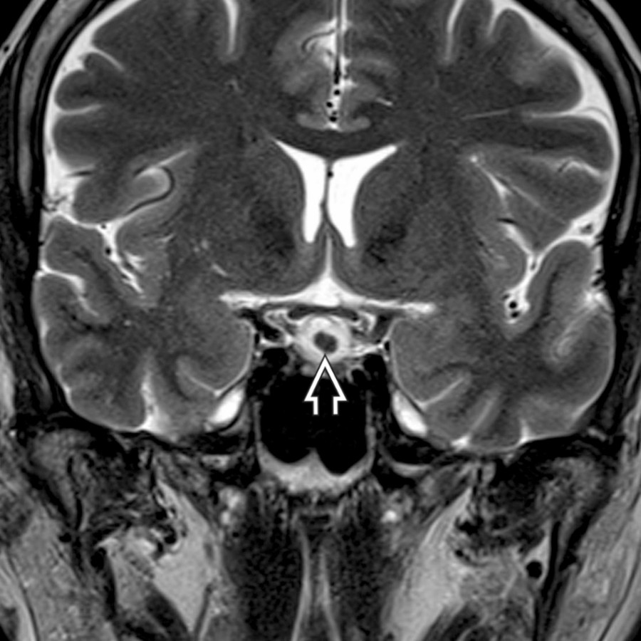 Coronal T2 MR in the same patient shows a hyperintense cyst with a hypointense, intracystic nodule . An intracystic nodule may be seen in up to 75% of Rathke cleft cysts and is a helpful clue to the correct diagnosis.