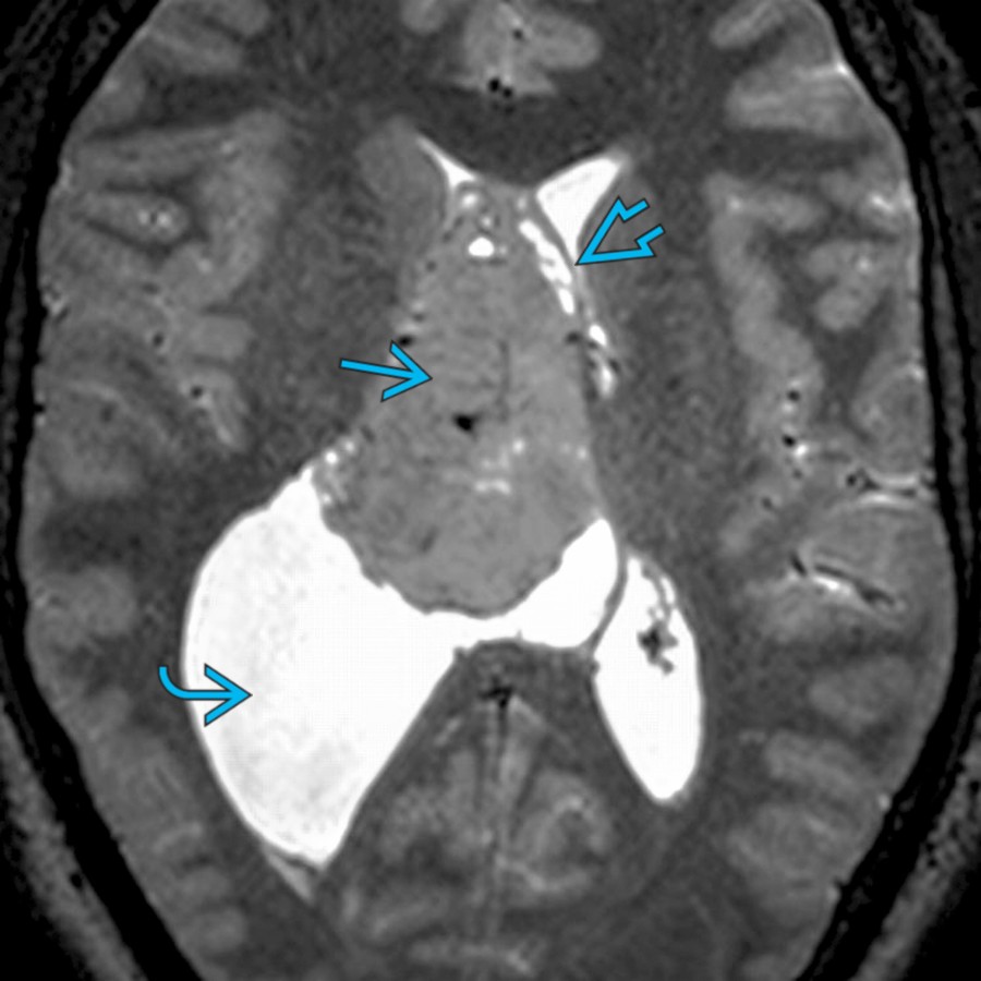 Axial T2 MR shows a large ventricular mass  in the frontal horn and anterior body of the right lateral ventricle. There is dilatation of the posterior body of the right lateral ventricle  and displacement of the septi pellucidi  to the left. On histopathology, this was a central neurocytoma.