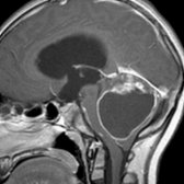 Sagittal T1 C+ MR shows a large, cystic mass  with rim enhancement and an eccentric, enhancing nodule . Mass effect on the 4th ventricle → obstructive hydrocephalus. Cyst contents are mildly hyperintense to CSF. Pilocytic astrocytoma was confirmed surgically.