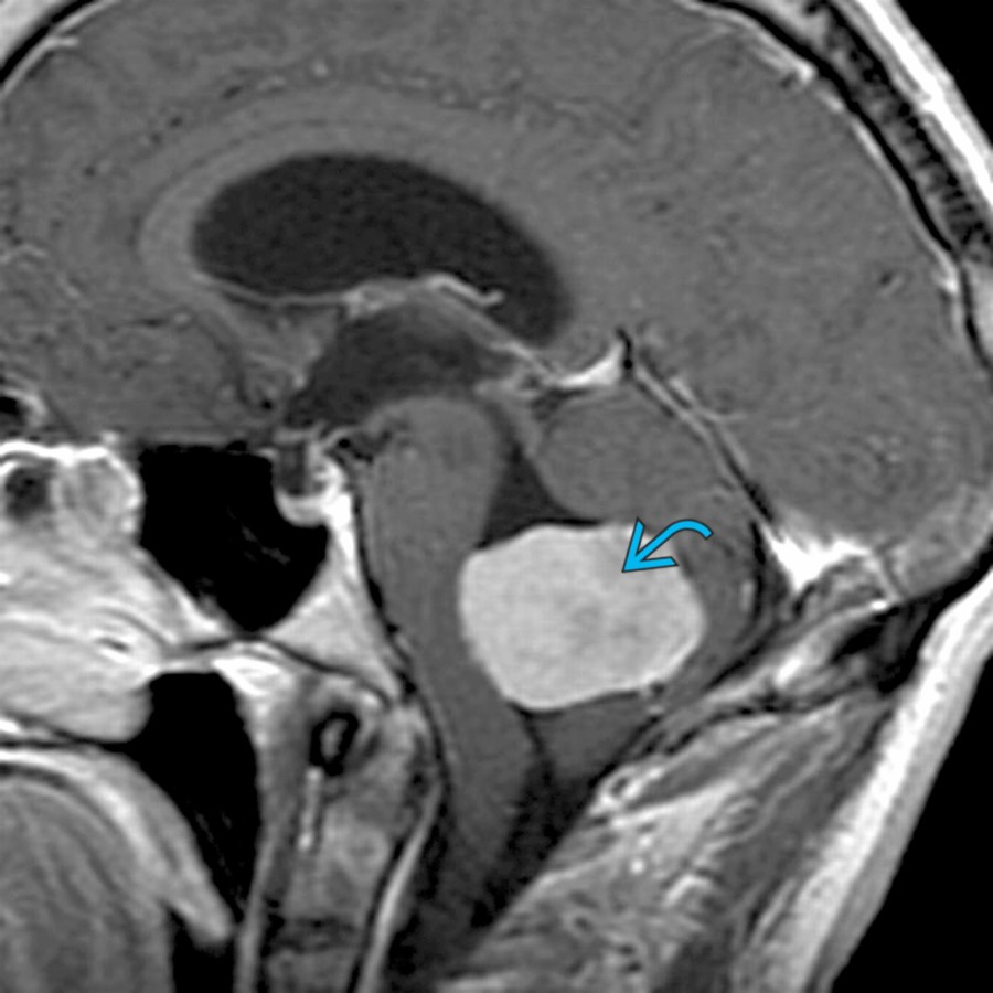 Sagittal T1 C+ MR shows a large homogenously enhancing 4th ventricular mass , which on pathology was a meningioma. There is dilatation of the ventricular system proximal to the mass.