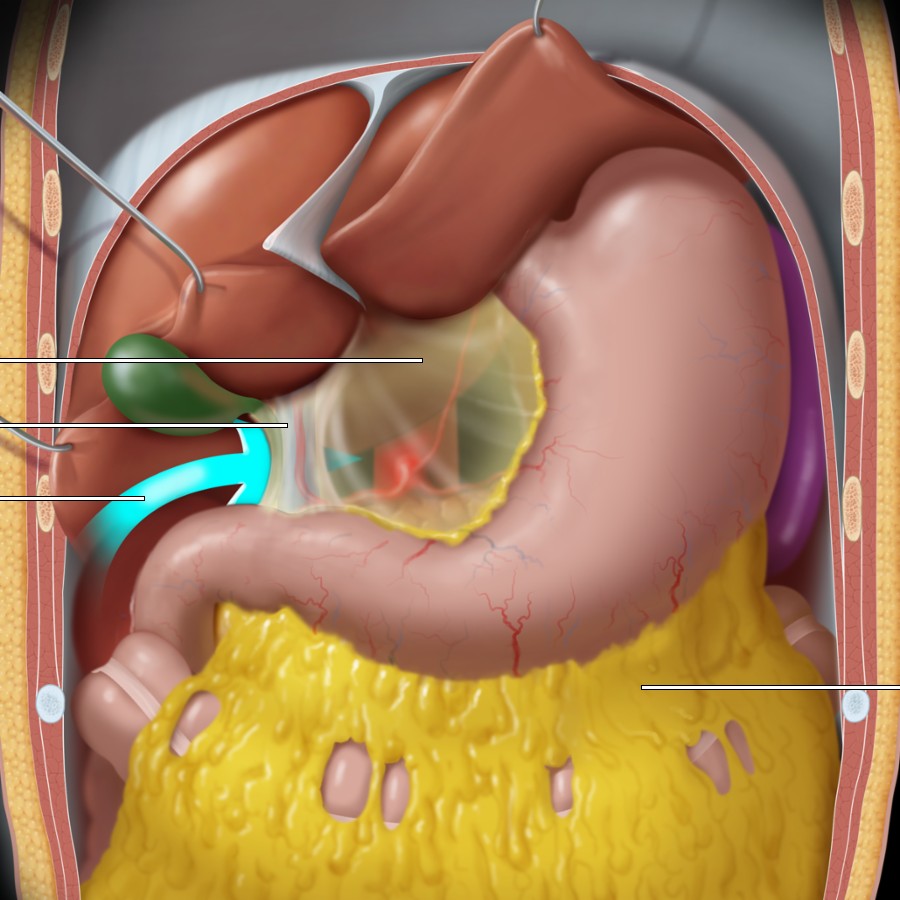 The liver has been retracted upward in this graphic, revealing the lesser omentum. The lesser omentum, which is composed of the hepatoduodenal and hepatogastric ligaments, forms part of the anterior wall of the lesser sac and conveys the common bile duct, hepatic artery, portal vein, and gastric arteries. The aorta and celiac artery can be seen through the lesser omentum, as they lie just posterior to the lesser sac. The greater omentum is seen on this graphic as a large fatty apron extending from the stomach downward along the anterior abdomen.