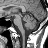 Sagittal T1WI MR in normal healthy subject shows normal appearance of superior and inferior colliculi .