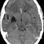 Axial CECT demonstrates an ovoid, well-circumscribed, CSF-density structure, consistent with an enlarged perivascular space  in the posteroinferior aspect of the right putamen. Enlarged perivascular spaces are isodense/isointense to CSF on CT/MR.
