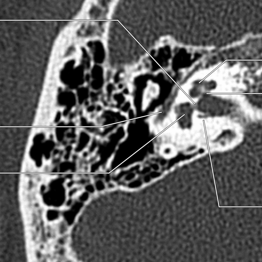 Second bone CT shows the tympanic segment of the right facial nerve. Note the inferior vestibular nerve & singular nerve.