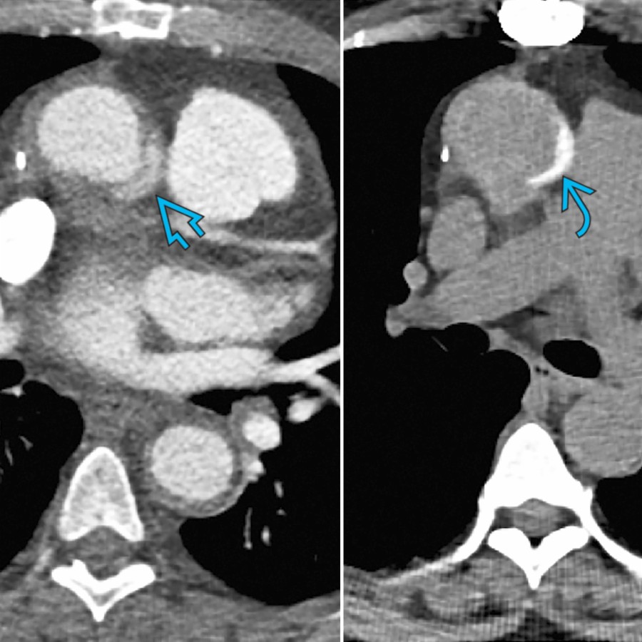 Composite image with axial CECT (left) and NECT (right) shows focal dilation of the ascending aorta with high attenuation in the expected location of the medial aortic wall  representing postsurgical material  rather than aortic pathology.