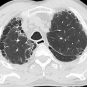 Axial HRCT of a 62-year-old man with upper lobe-predominant fibrosis from chronic hypersensitivity pneumonitis shows tracheal dilatation  and upper lobe predominant honeycombing .