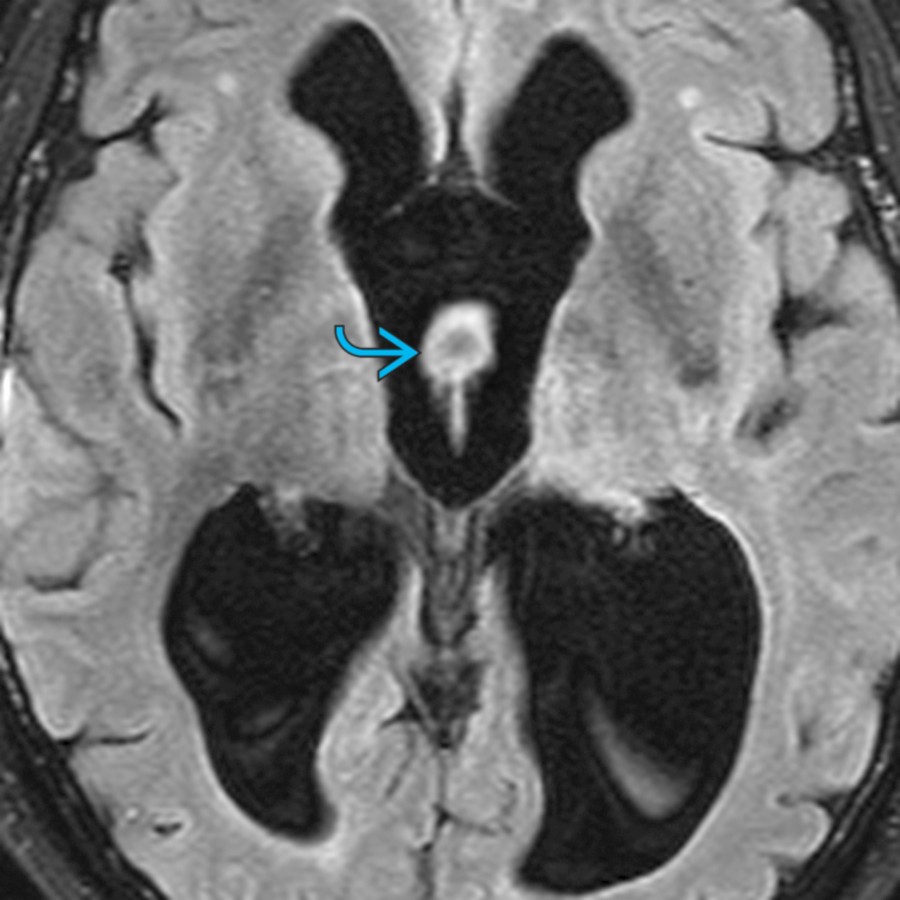 Axial FLAIR MR in a patient with hydrocephalus demonstrates focal hyperintensity  in the 3rd ventricle due to a pseudomasses caused by pulsatile CSF.