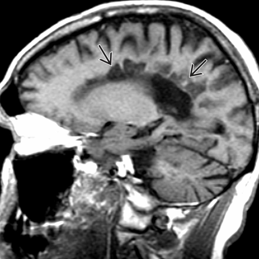 Sagittal T1 MR shows multiple hypointense lesions ("black holes") in the deep white matter  related to axonal destruction. Note the associated moderate ventricular and sulcal enlargement.