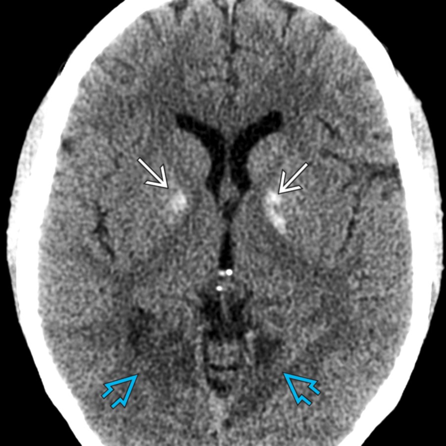 Axial NECT shows Ca⁺⁺ of the GP bilaterally  in this child with MELAS. Note the low density in the medial occipital lobes related to  infarcts. BG Ca⁺⁺ is abnormal in children & young adults.