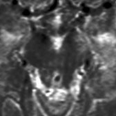 Axial T2WI MR in the same patient illustrates the hyperintense signal within the left cerebral peduncle  from WaD.