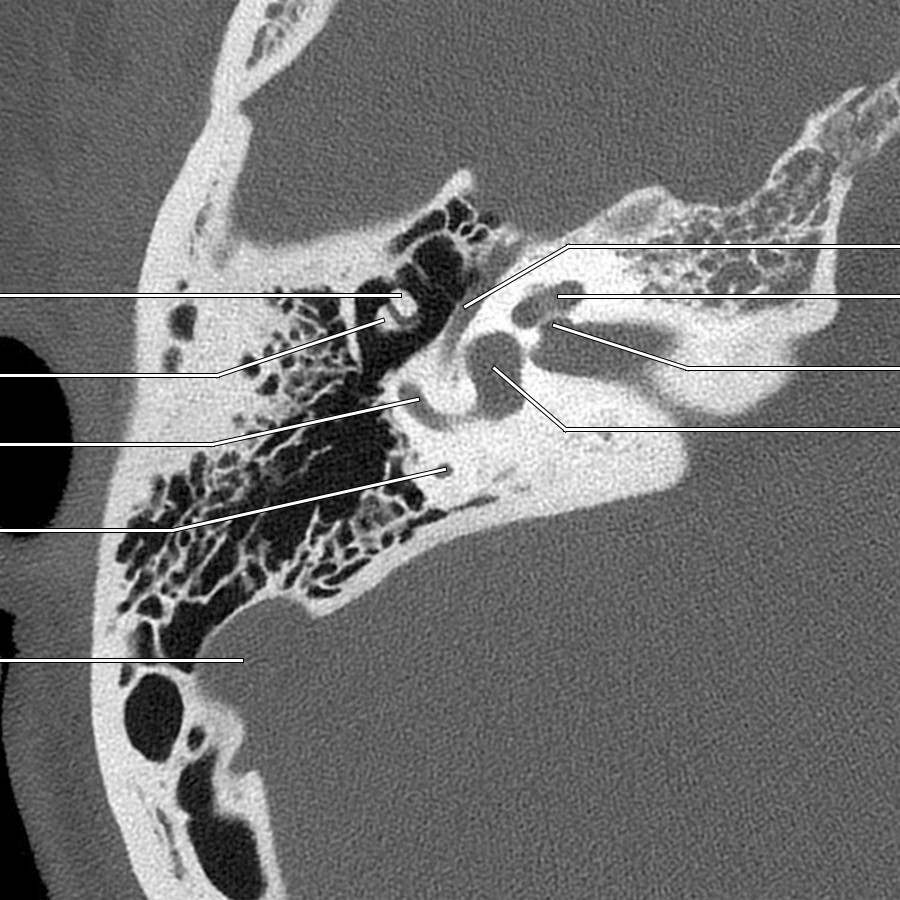 This image demonstrates the tympanic segment of CNVII arising from the geniculate ganglion and traversing posteriorly and laterally to take a 2nd turn downward, forming the posterior genu (not shown).