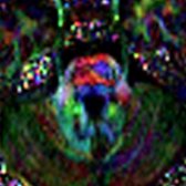 Axial DTI in the same patient shows decreased fractional anisotropy in the right pontine corticospinal tract  due to WaD. Note intact CST on the contralateral side .