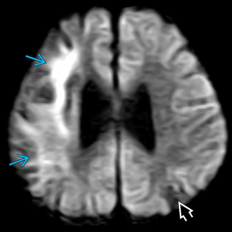 Axial DWI MR in the same 2-year-old girl with moyamoya-type vasculopathy shows diffusion restriction in the right frontoparietal foci of signal abnormality , suggesting an acute/subacute infarct. However, there is no diffusion restriction in the left parietal region , suggesting this infarct is of an older age.
