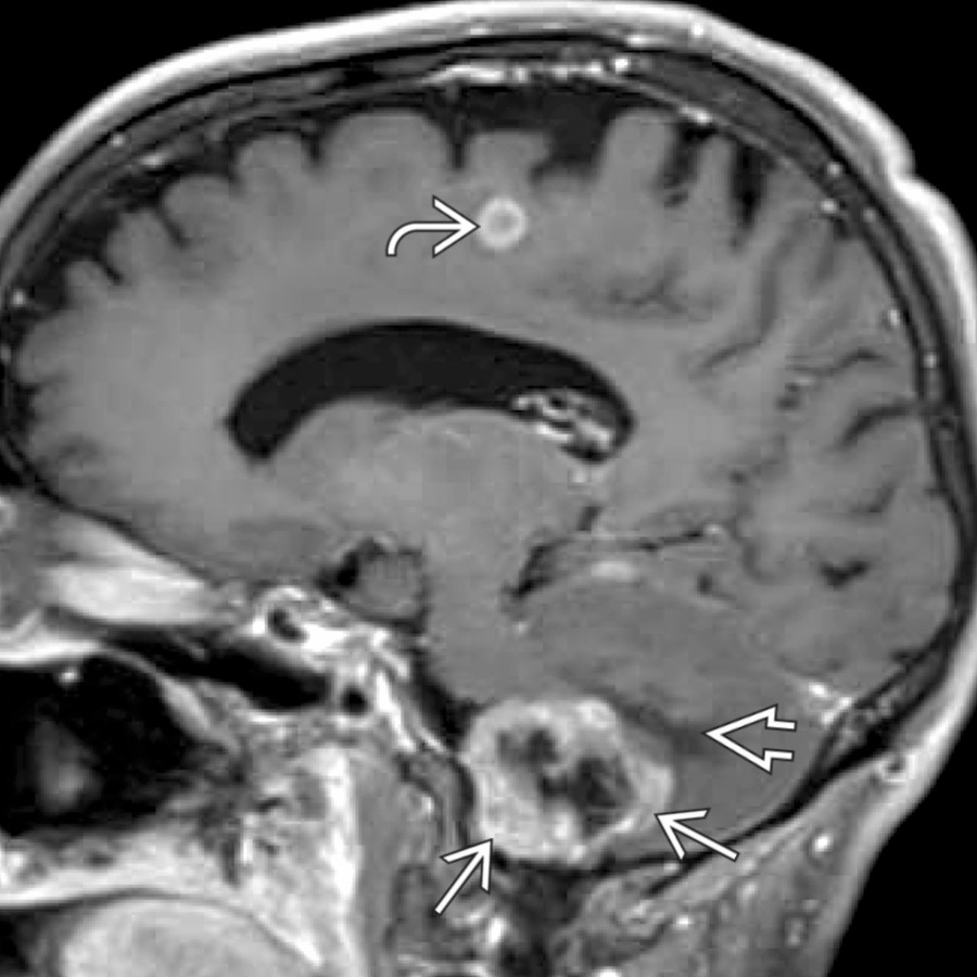 Parasagittal T1 C+ FS MR shows a heterogeneous, cystic enhancing mass  in the right CPA  . Adjacent brain edema is noted . Although the mass might mimic a cystic schwannoma, the presence of a 2nd enhancing mass and a clinical history of lung cancer helps establish diagnosis of metastasis.