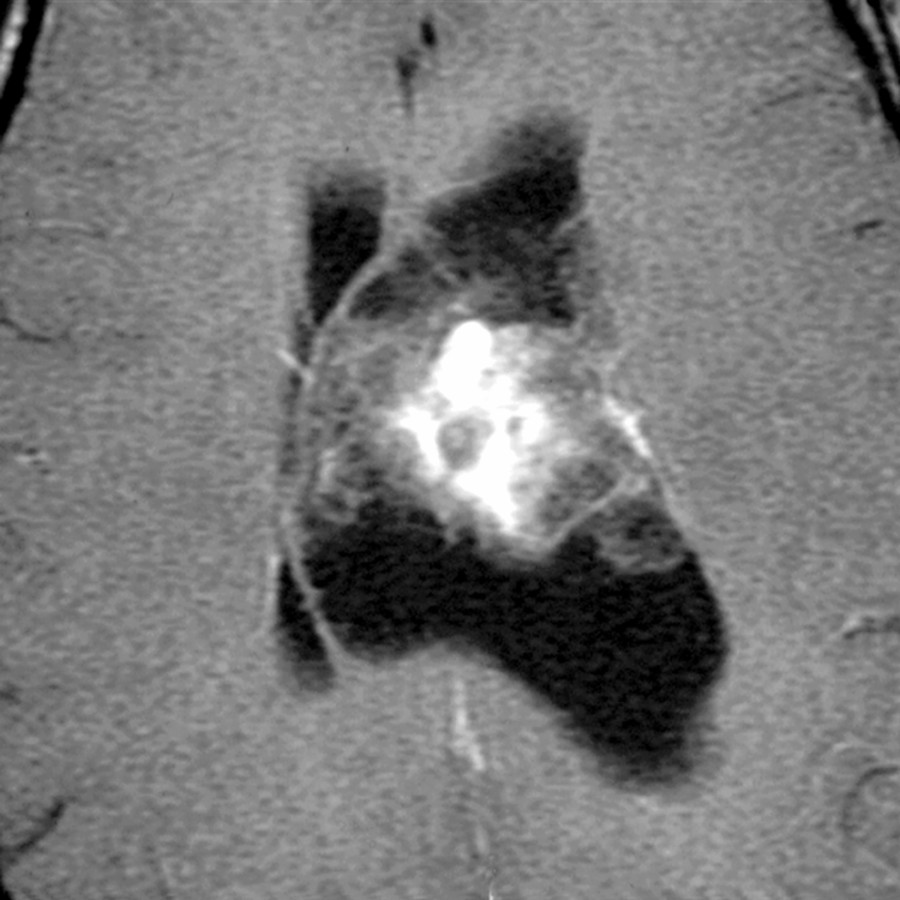Axial T1 C+ MR in a 33 year old with headaches shows an inhomogeneously enhancing bubbly lesion in the body of the left lateral ventricle. The appearance and location distinguish a central neurocytoma from subependymoma and other possible lateral ventricular masses, such as a meningioma.