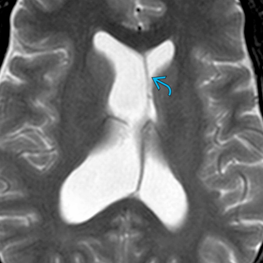 Axial T2 MR shows normal asymmetry of the lateral ventricles with the right being larger than the left. The septi pellucidi  are slightly bowed and displaced across the midline. When there is lateral ventricular asymmetry, it is important to scrutinize the region of foramen of Monro to exclude any obstructing pathology.