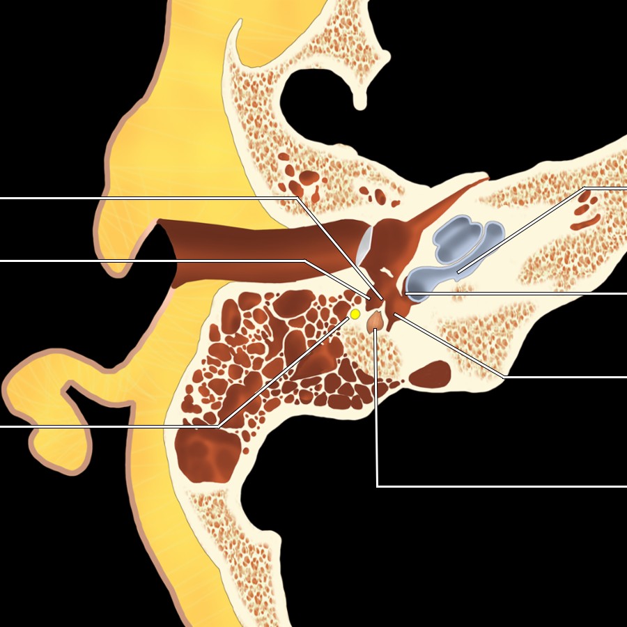 Axial graphic shows the posterior wall of the mesotympanum with small, air-filled areas (called sinus tympani) medially & facial (CNVII) recess laterally with the bony pyramidal eminence in between.