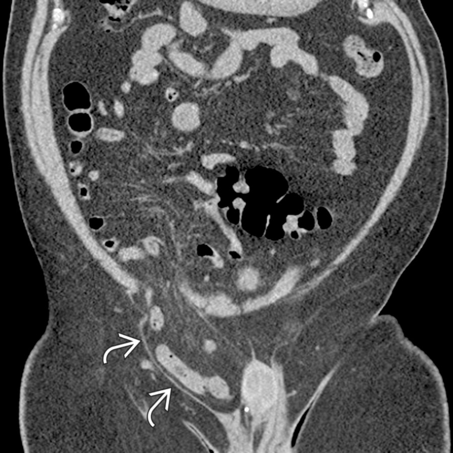 Coronal NECT shows a large right inguinal hernia  containing loops of small bowel without evidence of obstruction. In most cases, inguinal hernias can be palpated and diagnosed clinically.