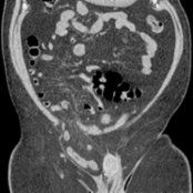 Coronal NECT shows a large right inguinal hernia  containing loops of small bowel without evidence of obstruction. In most cases, inguinal hernias can be palpated and diagnosed clinically.