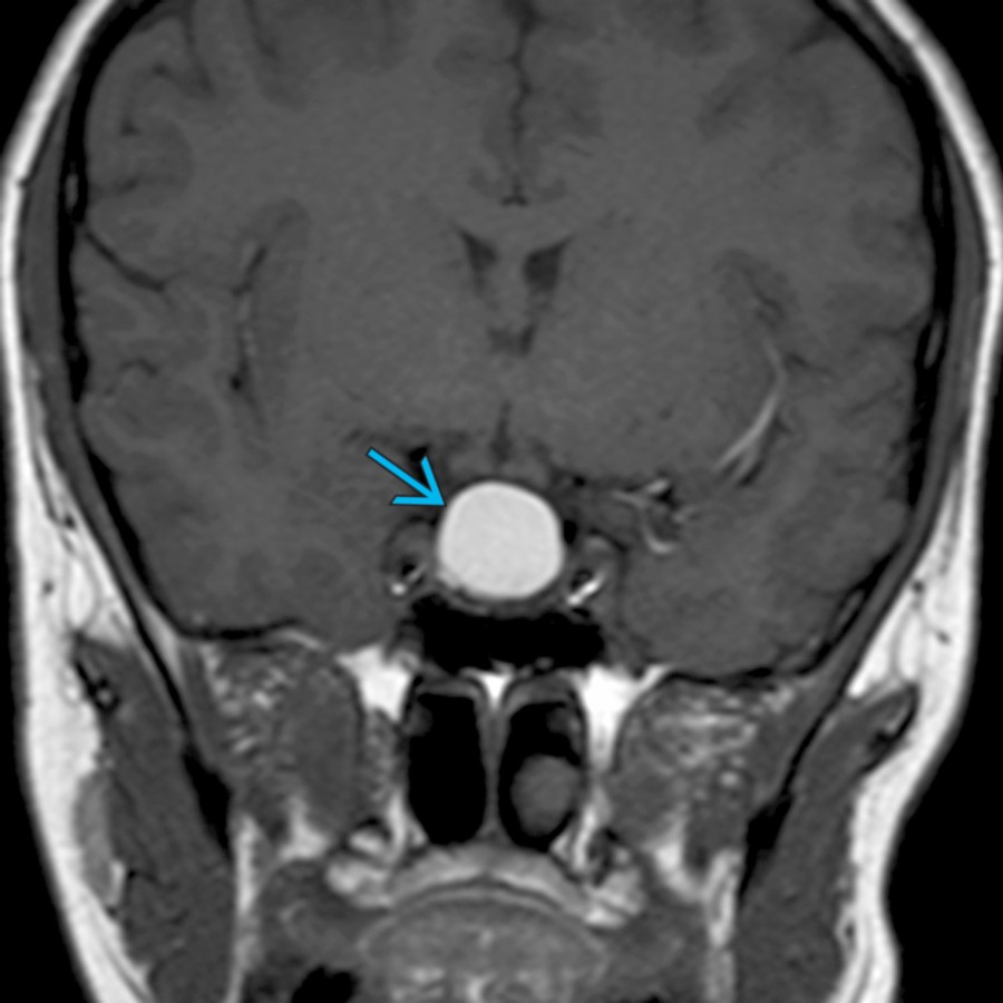 Coronal T1 MR in a 21-year-old woman with amenorrhea shows a hyperintense sellar and suprasellar mass . Rathke cleft cyst was found at resection. Mass effect from the lesion size caused symptoms in this case. Small Rathke cleft cysts are most commonly asymptomatic and may be managed conservatively.