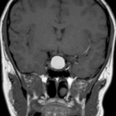 Coronal T1 MR in a 21-year-old woman with amenorrhea shows a hyperintense sellar and suprasellar mass . Rathke cleft cyst was found at resection. Mass effect from the lesion size caused symptoms in this case. Small Rathke cleft cysts are most commonly asymptomatic and may be managed conservatively.