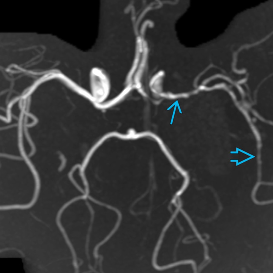 3D MRA of the circle of Willis in the same patient shows irregular narrowing of the left proximal   and distal  segments of the middle cerebral artery, consistent with vasculitis.