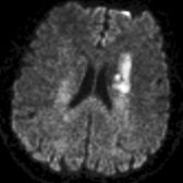 Axial DTI trace image shows increased signal in the left corona radiata/CST related to an acute infarct . DTI may distinguish between the primary lesion and associated WaD. Reduced fractional anisotropy may be seen in the affected CST.