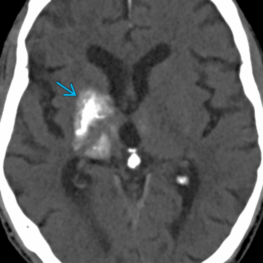 Axial NECT shows dense Ca⁺⁺ in right BG  & thalamus. CE images (not shown) revealed an underlying developmental venous anomaly. These are congenital cerebral vascular malformations with mature venous elements, which may rarely have Ca⁺⁺ possibly related to underlying venous congestion & ischemia.