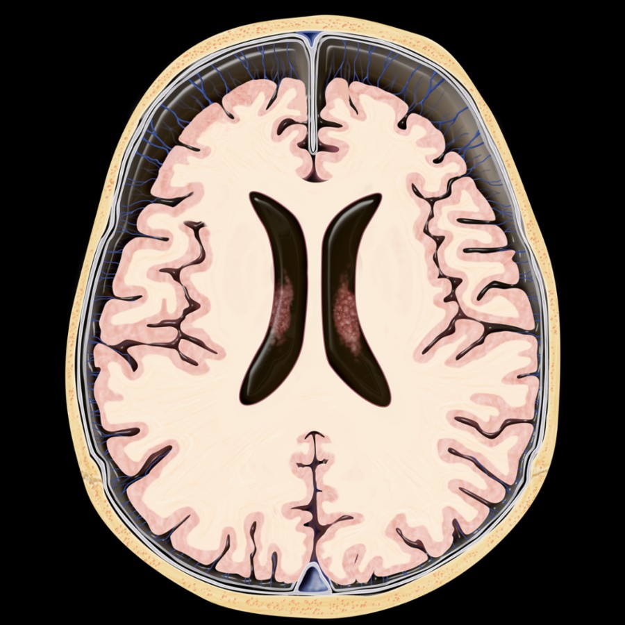 Axial graphic shows classic enlarged subarachnoid spaces (SAS) in a macrocephalic infant (head circumference > 95%). Note the symmetric enlargement with idiopathic enlargement of SAS during the 1st year of life.