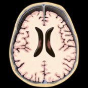 Axial graphic shows classic enlarged subarachnoid spaces (SAS) in a macrocephalic infant (head circumference > 95%). Note the symmetric enlargement with idiopathic enlargement of SAS during the 1st year of life.