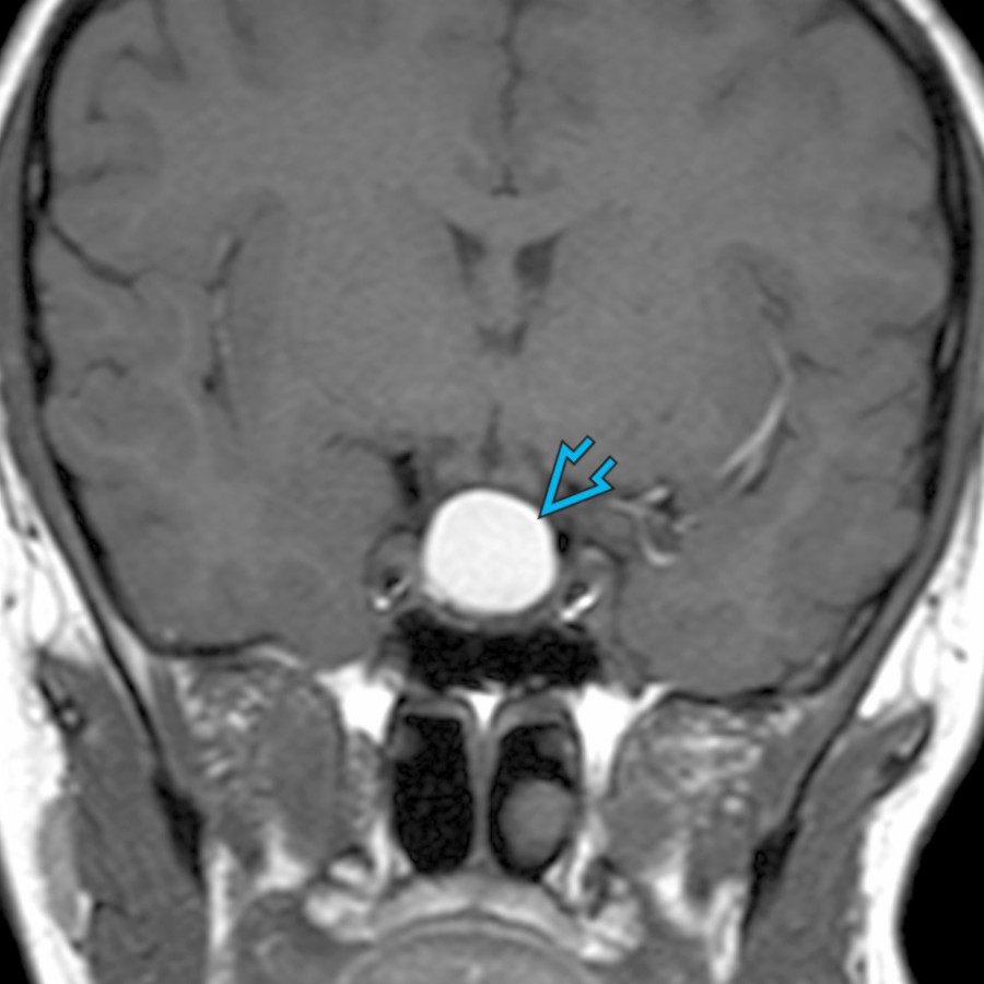 Coronal T1 MR shows a hyperintense suprasellar mass . No enhancement was present. Rathke cleft cysts are benign and may become symptomatic when large, resulting in mass effect on the surrounding structures.