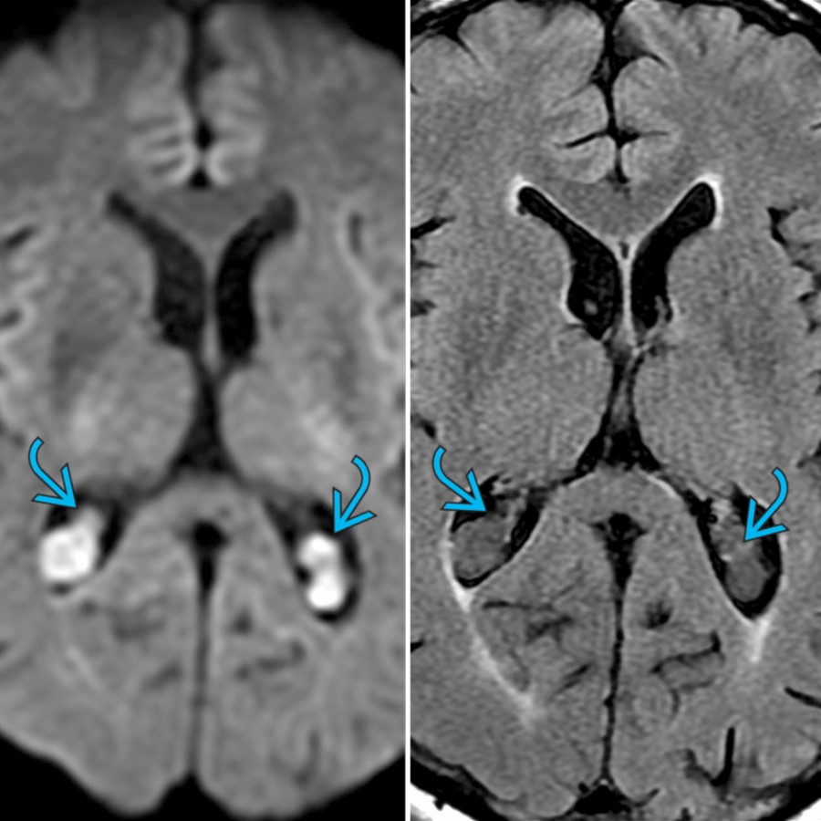 Axial DWI (L) and axial FLAIR MR (R) shows characteristic large choroid plexus cysts  in the atria of both lateral ventricles. Choroid plexus cysts, often called choroid plexus xanthogranuloma, are nonneoplastic noninflammatory cysts and are often bright on DWI.