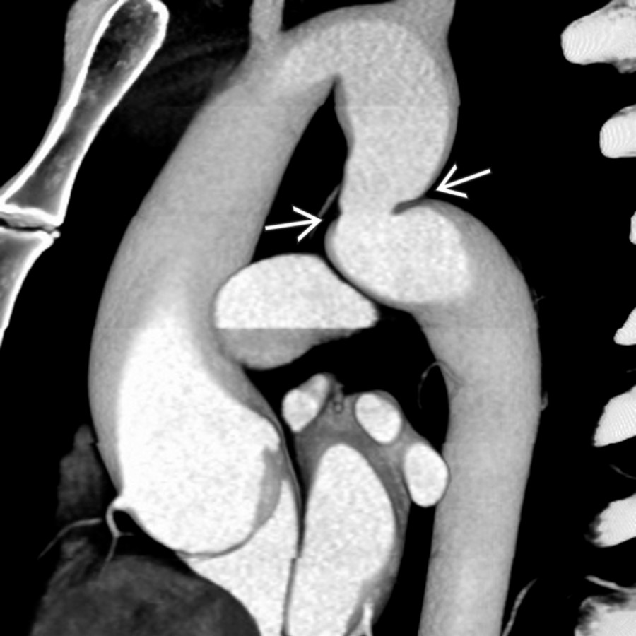 Sagittal oblique volume-rendered CTA shows kinking and mild narrowing  of the proximal descending aorta at the level of the ligamentum arteriosum, consistent with pseudocoarctation. No enlarged collateral bronchial, intercostal, or internal mammary arteries are present.