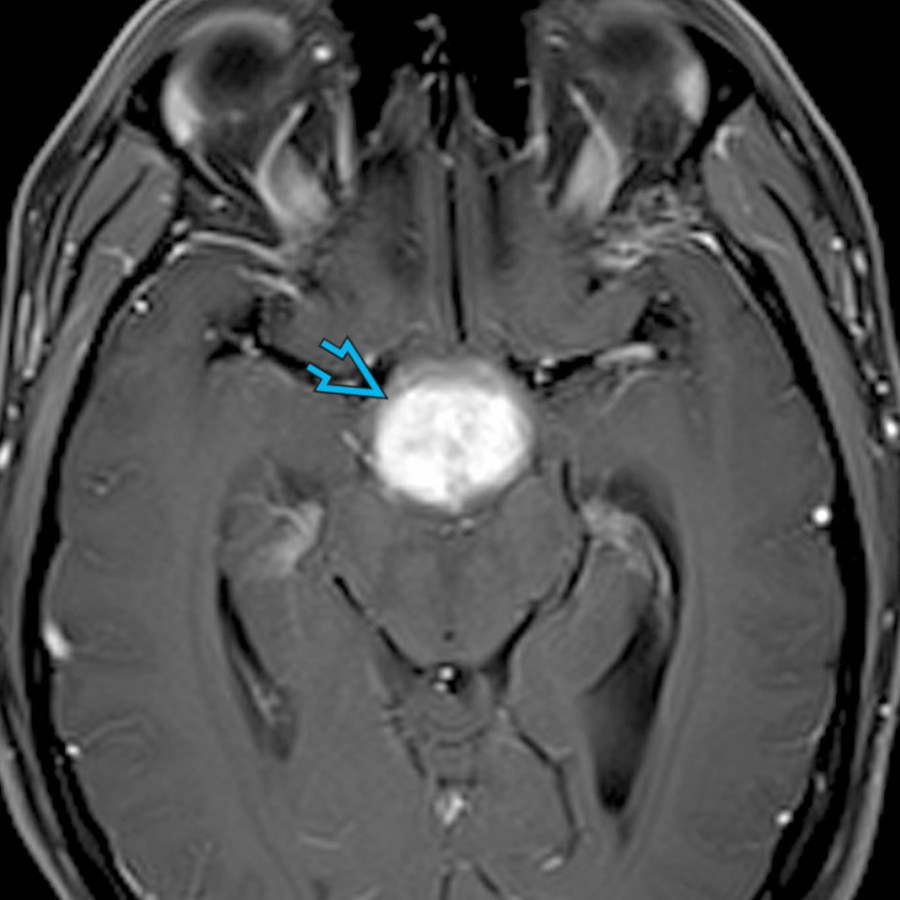 Axial T1 C+ FS MR shows a diffusely enhancing suprasellar mass  in a young adult who first presented with diabetes insipidus and a thick, enhancing infundibulum with absence of a posterior pituitary bright spot. Nine months later, patient returned with a much larger suprasellar mass.