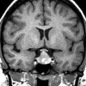 Coronal T1 MR in a 21-year-old woman, with sudden-onset headache and decreased T4, shows a hyperintense mass  with even more hyperintense intracystic nodules . The preoperative diagnosis was pituitary apoplexy, and Rathke cleft cyst apoplexy was found at surgery.