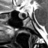 Sagittal T2 MR shows a well-delineated, extremely hypointense mass  found incidentally in an asymptomatic patient. This was presumed to be a Rathke cleft cyst.