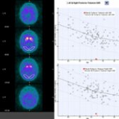 Quantitative analysis of I-123 ioflupane SPECT in the same patient shows the bilateral posterior putamina have abnormally low uptake  of radiotracer compared with normal controls. Visual analysis of the putamina  supports the quantitative analysis.