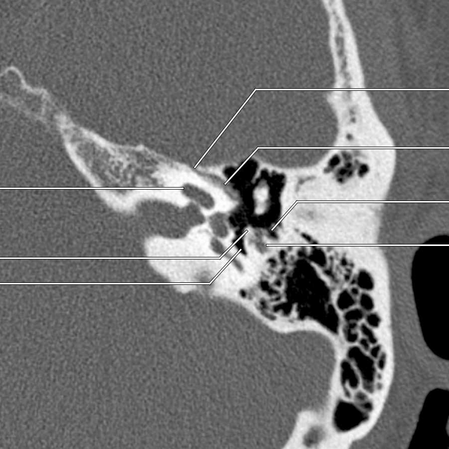 At the level of the oval window, the mastoid segment is visible deep to the facial nerve recess. Notice the more medial pyramidal eminence and sinus tympani.