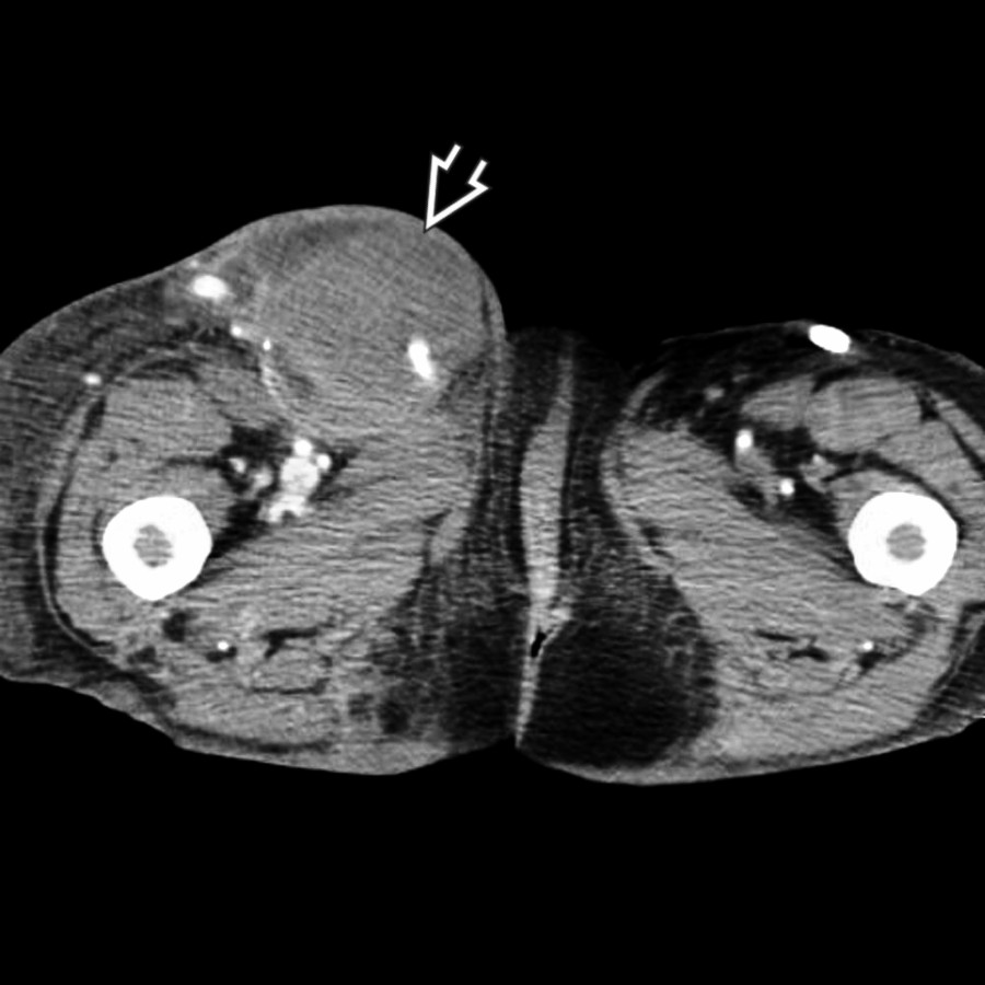 Axial CECT shows a groin hematoma  that resulted from surgical revision of an AV fistula for dialysis. Unlike a pseudoaneurysm, there is no enhancement of the mass.