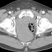 Axial CECT demonstrates a large,  homogeneous mass  in the deep pelvis involving the rectosigmoid colon and portions of the small bowel. While this was prospectively thought to perhaps be a gastrointestinal stromal tumor on imaging, it turned out to be a desmoid tumor at resection.