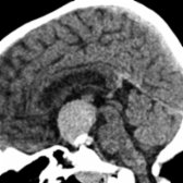 Sagittal NECT shows a mass in the suprasellar cistern with a hyperdense cyst  and calcification , consistent with craniopharyngioma. This is the most common suprasellar tumor in children.