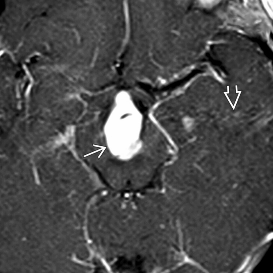 Axial T1 C+ MR shows a suprasellar enhancing mass  with prominent phase artifact  caused by large basilar tip aneurysm with slow intraluminal flow. Aneurysms are the 3rd most common suprasellar mass in an adult.