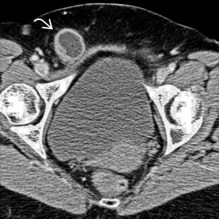 Axial CECT in the same patient at a lower level identifies the source of the obstruction: Small bowel trapped in the femoral canal .