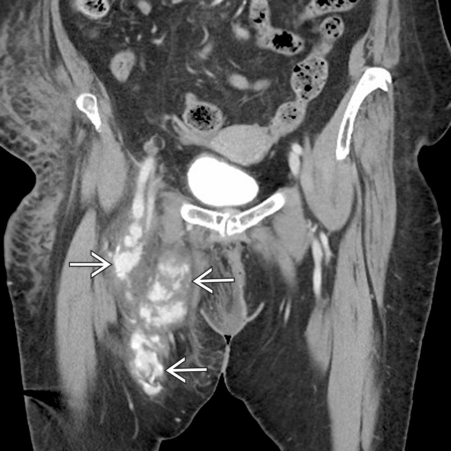Coronal CECT shows a large right groin hematoma with massive active extravasation of contrast . This patient had recently undergone a complicated right groin catheterization with subsequent severe blood loss.