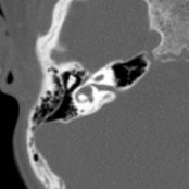 Axial bone CT in an infant with trisomy 21 and sensorineural hearing loss (SNHL) shows a small internal auditory canal (IAC) . The cochlear nerve canal (CNC) is absent. There is a mildly small horizontal semicircular canal (SCC) bone island .