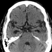 Axial NECT in a 59 year old with AD shows hippocampal atrophy is present, as evidenced by temporal horn enlargement . Both sylvian fissures are also very prominent. There was no evidence for intracranial mass lesion or ischemia/infarction.