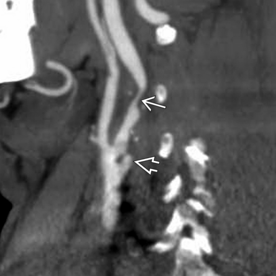 Sagittal reformat CTA demonstrates a high-grade stenosis of the internal carotid artery distal to its origin  and irregular narrowing and ulceration more proximally at the carotid bifurcation , findings typical for atherosclerotic narrowing.